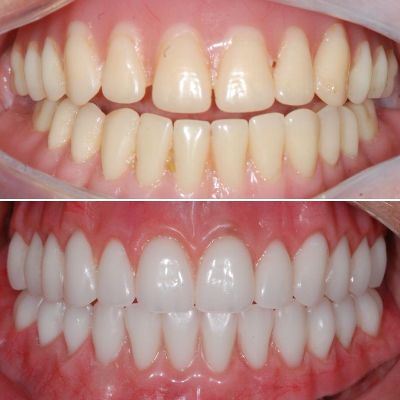 Antes e depois — arcada
