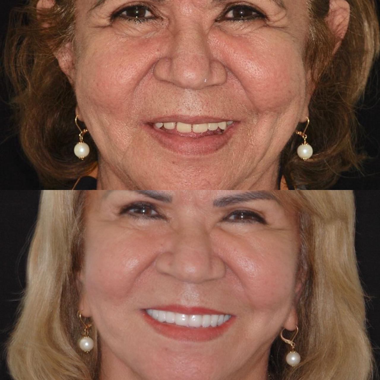 Antes e depois — reabilitação facial